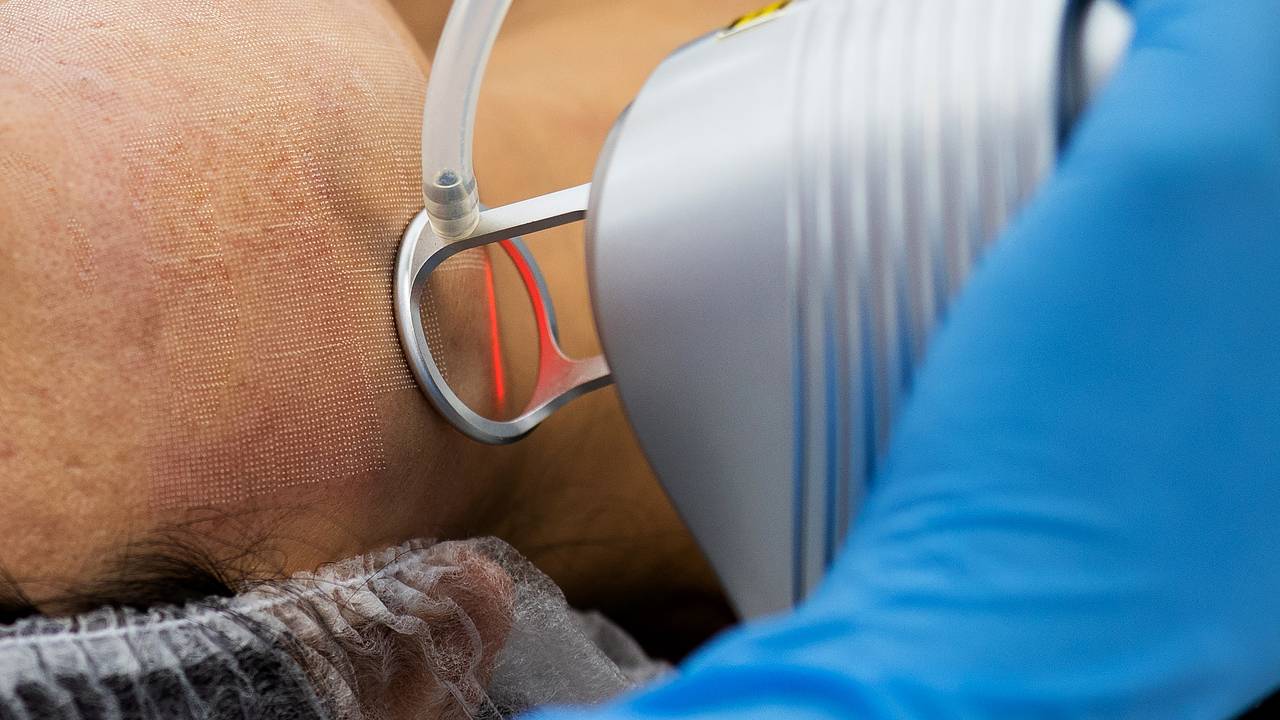 Россиянка сделала популярную процедуру и показала покрытое ранами лицо