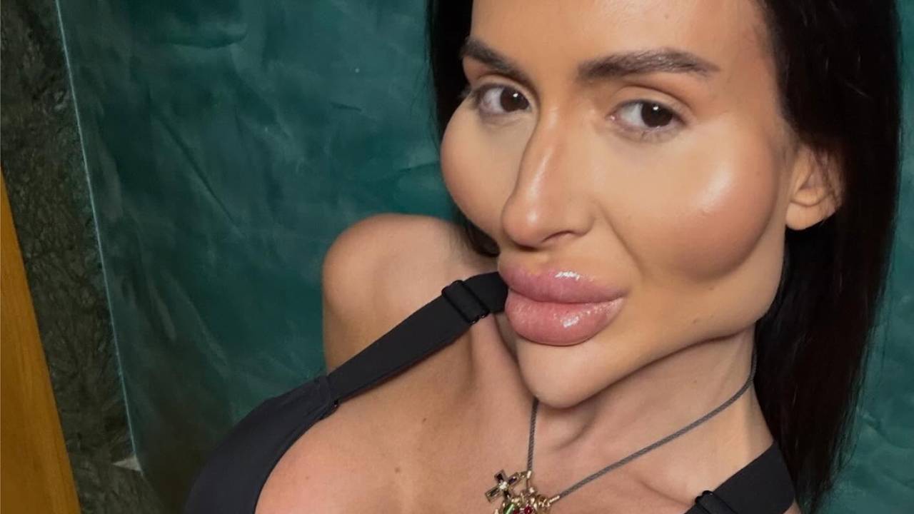 Женщина с самыми большими щеками в мире решила их уменьшить