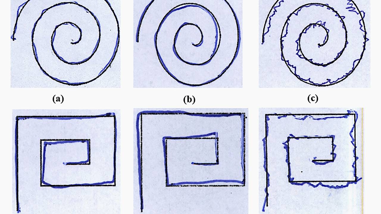 Открыт простейший способ выявления болезни Паркинсона Открыт простейший способ выявления болезни Паркинсона